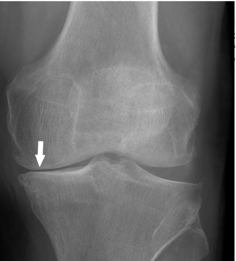 Knee MRI