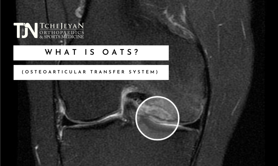 What is OATS (Osteoarticular Transfer System)