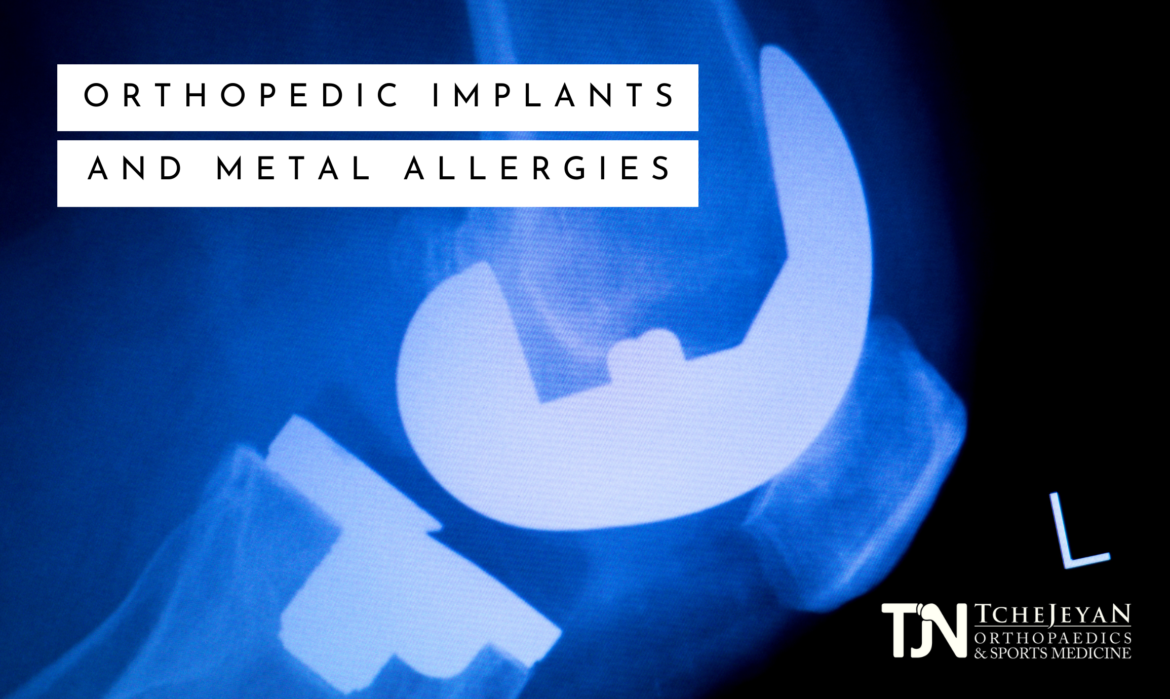 Orthopedic Implants & Metal allergies