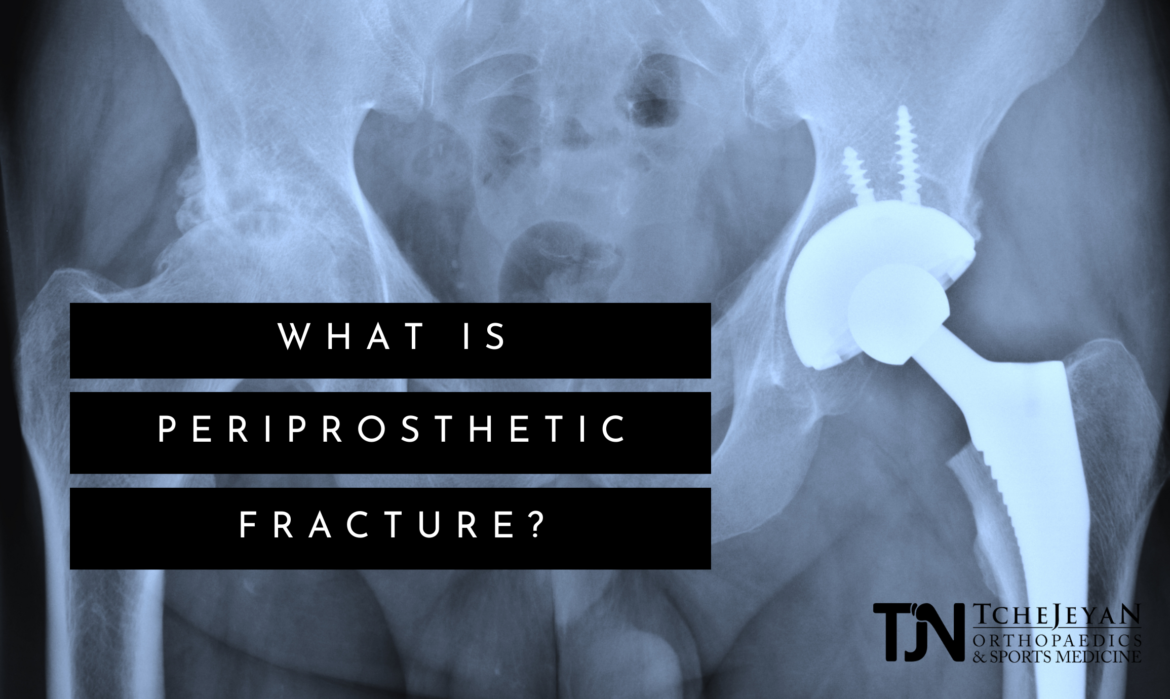 What is Periprosthetic Fracture?