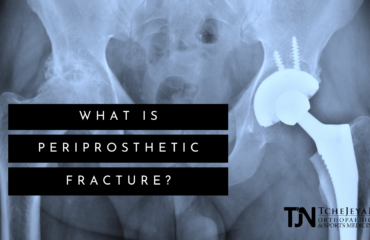 What is Periprosthetic Fracture?